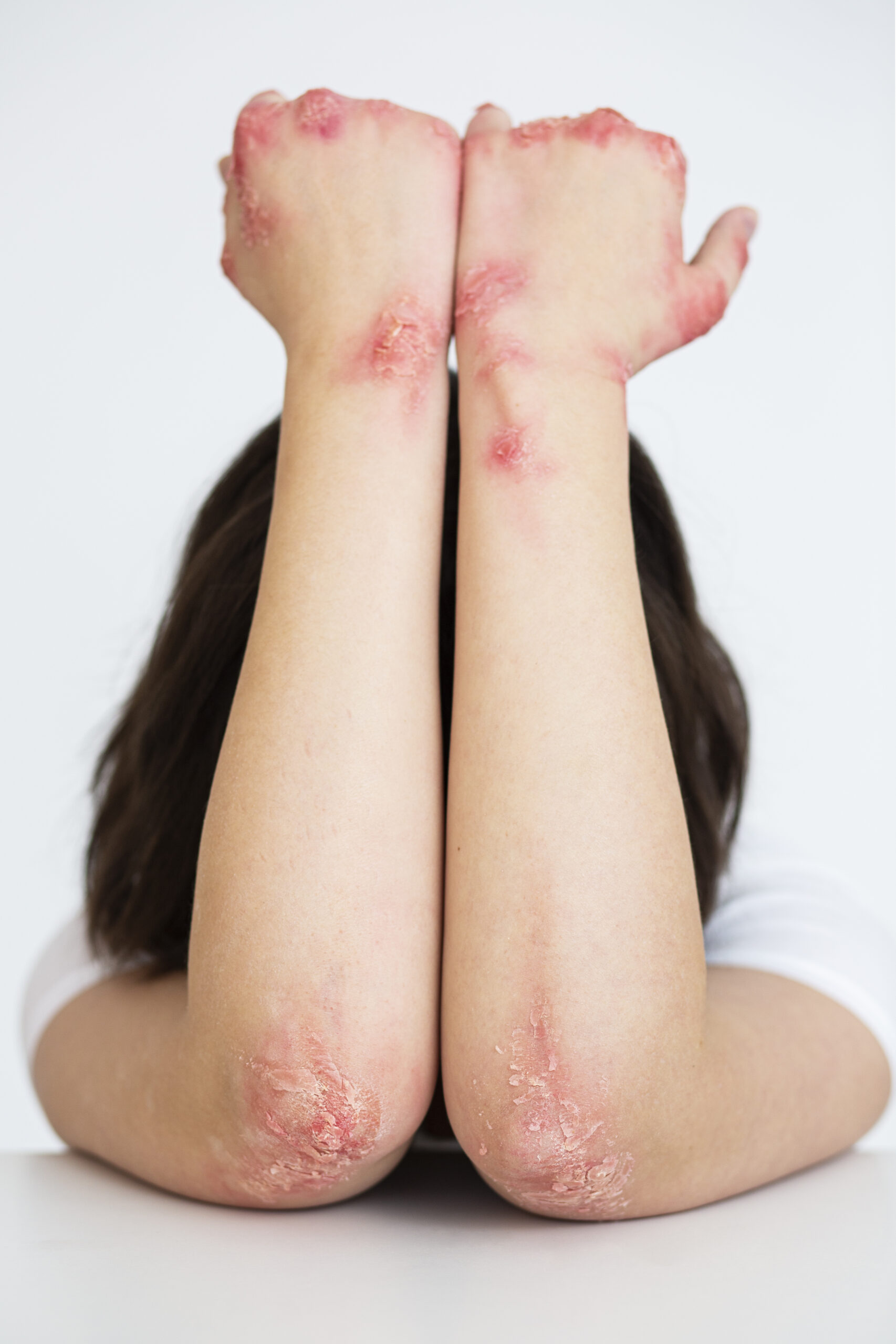 Scaling Herpes Zoster Vaccine Awareness Across Healthcare Professionals